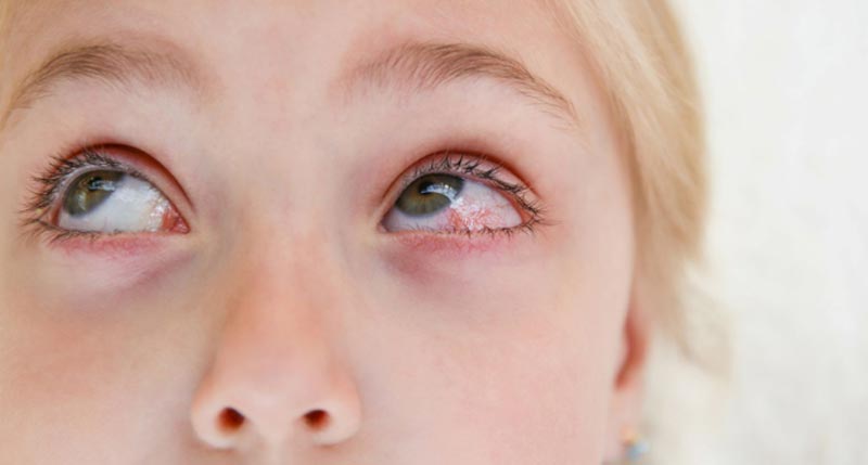 Help Your Student Avoid Pink Eye This School Year